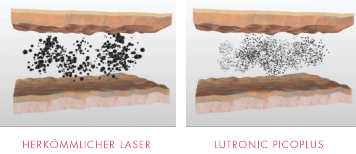 Laser Vergleich